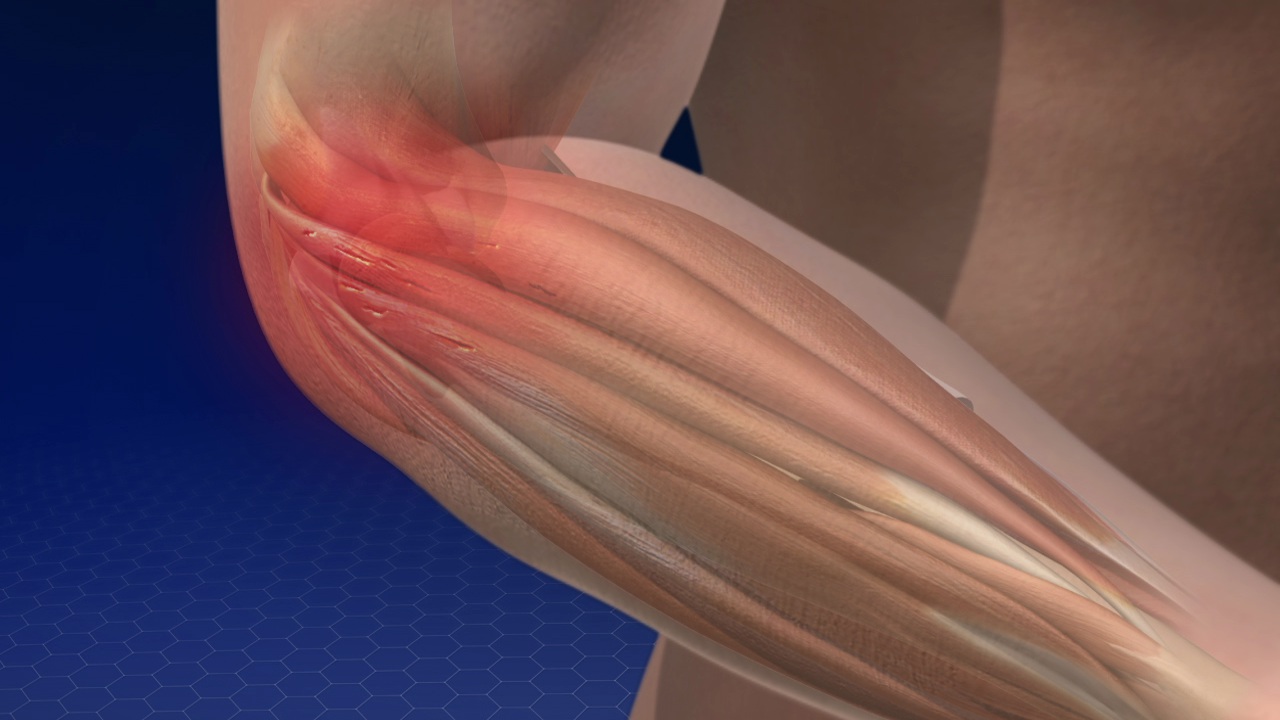 Causes Of Tennis Elbow | Understand The Concept | Learn With Jipsi